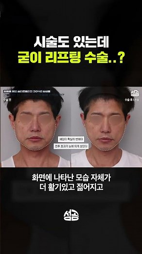 실리콘 밸리 남성들이 페이스리프팅 수술을 선호하는 이유?? #shorts #리프팅효과