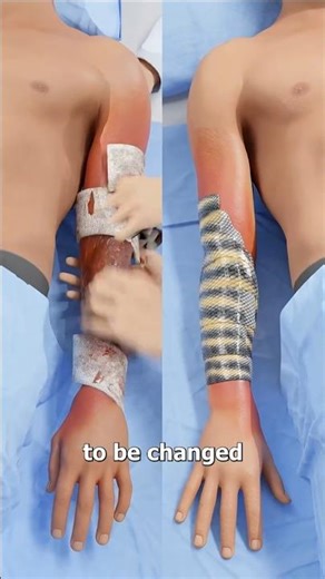Fish Skin Transplant Saves Man’s Hand Successfully #shorts #shortvideo