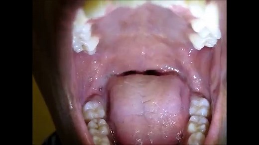 Tongue Exercises For Sleep Apnea