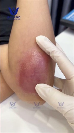 Large, inflamed arm abscess