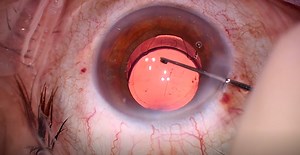 Femtis IOL Implantation - Eyetube