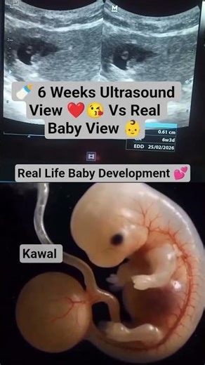 🍼 6 Weeks Ultrasound View ❤️😘 Vs Real Baby View 👶 #ultrasound #baby