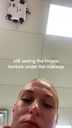 #acne #acneskin #acnemakeup #makeup | makeup