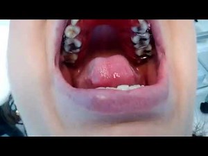 Watch the easy way to use the bite plane for yourself