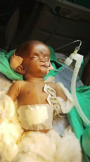 congenital VP Shunt Surgery 🩺💉💊🏥🙏🙏