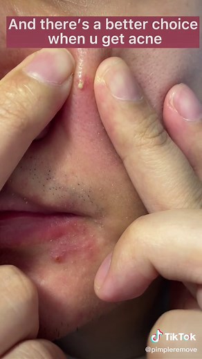 Safe and Effective Acne Popping Tips