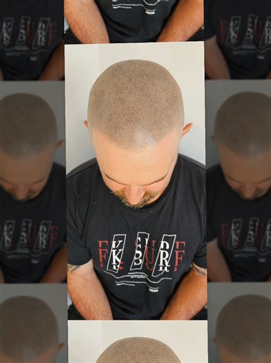 NEW Year, NEW You at Alchemy SMP ✨️ Omg I love my job! Great day completing a third session for pure ray of sunshine Mick 🙌 Before and after! Need I say more 🔥 His complete treatment was $1500, and it will last around 7 to 10 years...so that's $150/year ✨️🙌 Forget about the sprays, powders, invasive hair transplants, and glue-on hair solutions 👀 👑 SMP is now the No.1 hair replacement solution available worldwide. It requires no maintenance, is non-invasive, safe, and provides instant result