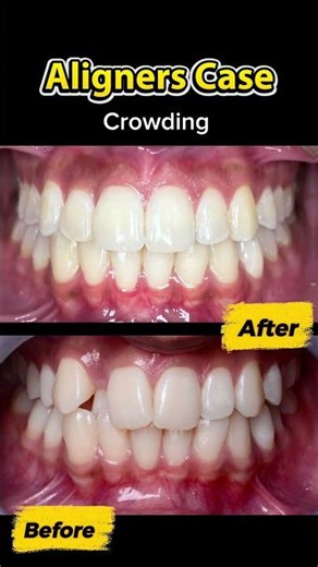 Crowding Fixed with Aligners | Before/After