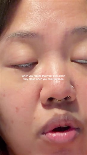 sleeping with one eye open… except it’s every second of the day 💀 #eyes #dryeyes #nocturnallagophthalmos #funny #humor