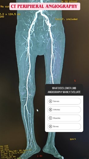 Mahesh Joshi on Instagram: "🩺 CT Peripheral Angiography – See Your Arteries Clearly! CT Peripheral Angiography is an advanced imaging test that provides a clear view of the arteries in your arms and legs. It helps in detecting: ✔️ Artery blockages ✔️ Narrowing (stenosis) ✔️ Blood clots ✔️ Vascular abnormalities 🔍 Useful when you have: • Leg pain while walking • Numbness or tingling • Cold feet or hands • Non-healing wounds • Suspected Peripheral Artery Disease (PAD) Fast • Painless • High-reso