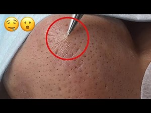 กดสิว blackheads filaments on nose remove with tweezers