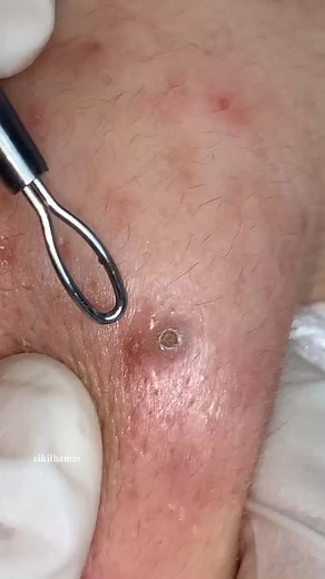 Effective Cheek Pimple Treatment Tips | Acne Fighter