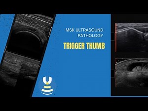 Trigger thumb demonstrated on ultrasound