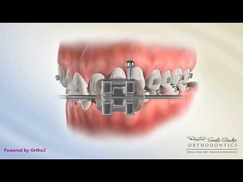 Damon Clear Bracket - Braces