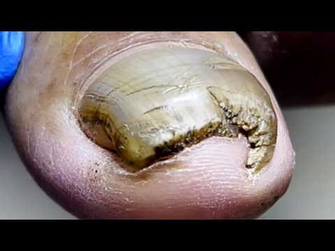 The Ingrown Nail On One Side Is Very Deep And Needs To Be Trimmed【Pedicure Master Lin Jun】