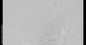 Angioplasty, balloon angioplasty and percutaneous transluminal angioplasty (PTA) for dialation vessel.