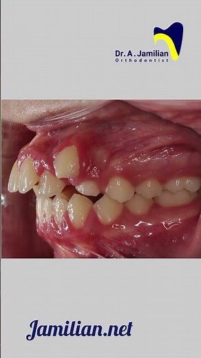 Braces for Class 2 | Full Orthodontic Treatment Explained with Real Case #dentist #orthodontics