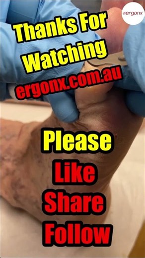 Say goodbye to that pesky little toe corn with this amazing removal method! 🙌✨ Watch as we