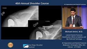 Lateral Clavicle Fractures: Classification, Which to Stabilize and My Preferred Technique