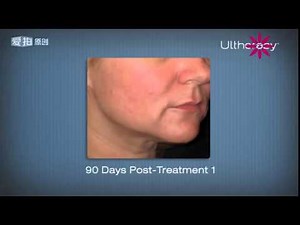 HIFU treatment Before and After