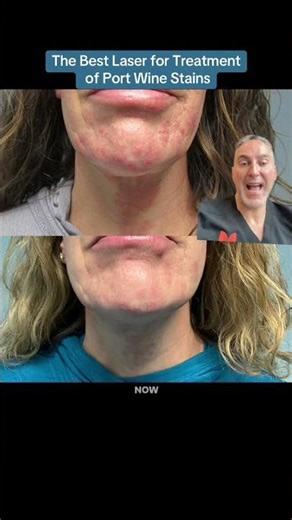 The Best Laser for Treatment of Port Wine Stains