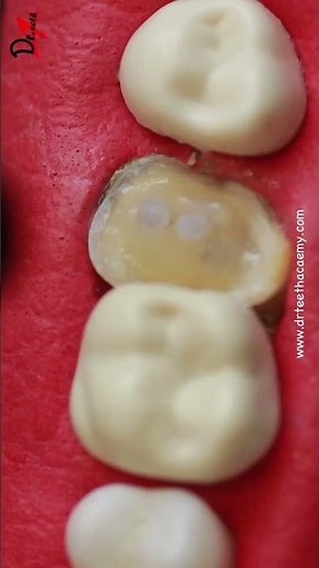 Deep cavity restoration #toothcaries #toothcavity