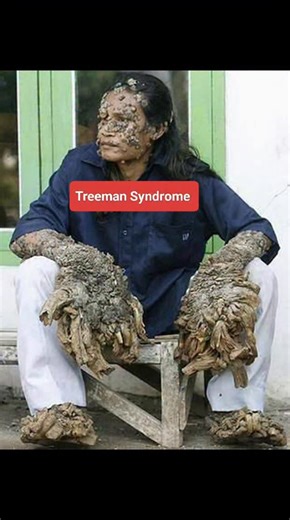 RK NURSE'S HUB on Instagram: "Tree man syndrome" is a colloquial name for epidermodysplasia verruciformis (EV), an extremely rare genetic skin disorder. It is characterized by a lifelong susceptibility to specific types of human papillomavirus (HPV), which leads to the growth of scaly macules, papules, and, in severe cases, massive bark-like cutaneous horns on the hands and feet. Key Facts (2026) Causes: Most cases are hereditary, caused by autosomal recessive mutations in the TMC6 (EVER1) or TM