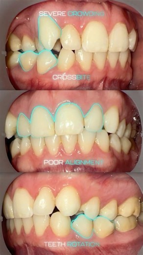 16 Week SMILE Progress ! 😱 Before vs. After Check-in with SMILE-FX® 💎