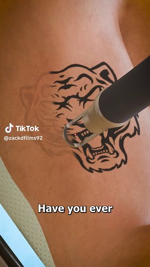 How Tattoos Are Removed: Understanding the Laser Tattoo Removal Process
