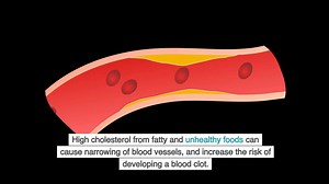 Cardiovascular Disease or CVD: Risk Factors and How to Reduce these There are several risk factors that can increase the chances of getting CVD. Having more risk factors usually means there is a greater risk of developing CVD. Reducing or eliminating these risk factors can significantly improve overall health of a person. This is the primary goal of raising awareness for the public so that everyone can take certain actions to tackle these modifiable risk factors. As well as improving health outc