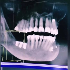 4 comments | Implantes Dentales. La Cone Beam se utiliza para...