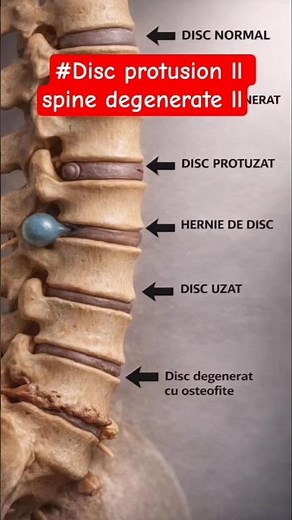 Disc Protrusion Explained | Spine Degeneration & Herniated Disc Treatment | Back Pain Relief