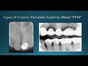 Interpretation of Restorative Material Source