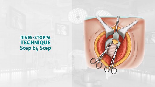 the-rives-stoppa-technique-for-incisional-hernias