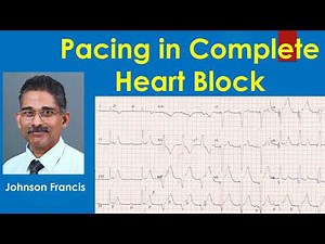 Pacing in Complete Heart Block – ECG