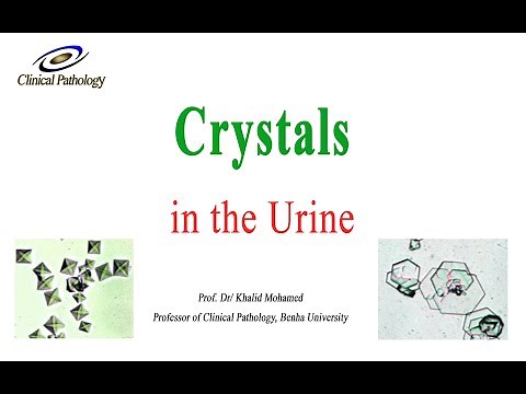 Urine analysis Part 4: Crystals in urine sediment