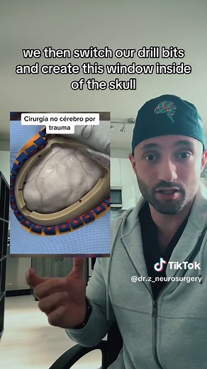 This is how we do brain surgery. 🧠 👨‍⚕️ #medtok #neurosurgery #brainsurgery #doctorexplains #surgery #braintumor #glioblastoma #brainbleedsurvivor #craniotomy #craniotomia #neurocirugia