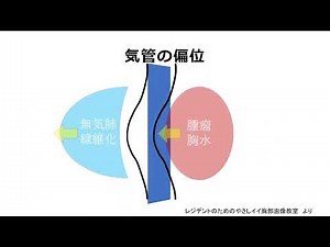 胸部X線写真読影キーワード解説動画4 気管の偏位
