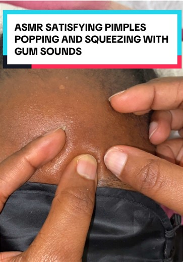 ASMR Satisfying Pimple Popping and Squeezing Sounds