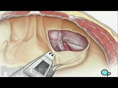 Hernia Repair Inguinal (Laparoscopic) - PreOp Patient Education Medical HD