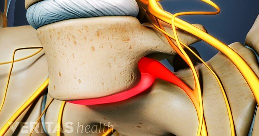 Spondylolysis and Spondylolisthesis