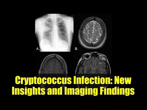 Cryptococcus Infection: New Insights and Imaging Findings