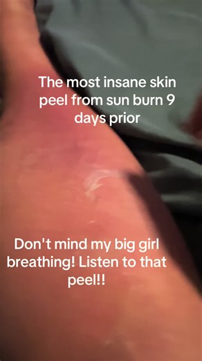 Satisfying Sunburn Skin Peeling Transformation