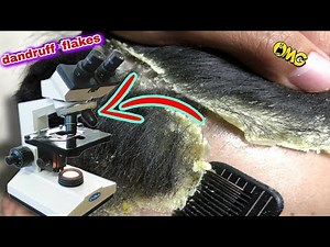 Dandruff and head and hair fungus under the microscope #microscope #Dandruff #bactria