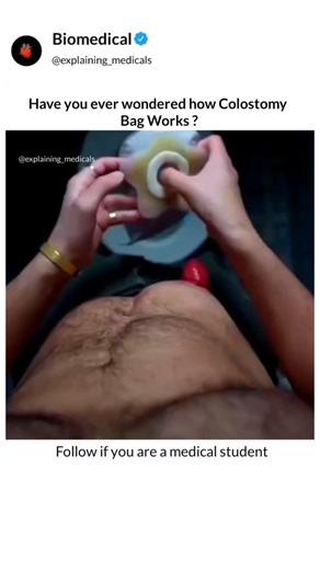 Explaining Medicals on Instagram: "Follow @explaining_medicals ⬇️⬇️⬇️⬇️ What text books can't show you, We animate. A colostomy bag is a medical pouch that collects waste when part of the large intestine is no longer able to pass stool normally. During a colostomy surgery, doctors create a small opening in the abdomen called a stoma. The healthy end of the colon is gently brought out through this opening, allowing waste to leave the body safely. The colostomy bag sticks securely over the stoma a
