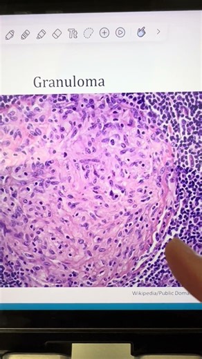 How to identify a granuloma on histology #biology #sarcoidosis