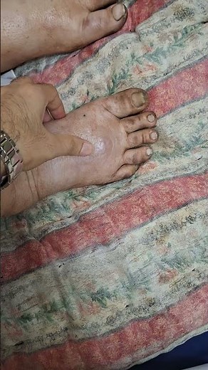 Pedal edema | Pitting edema #clinicalexamination #foot