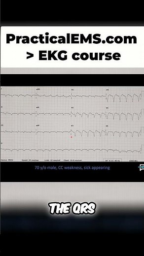 VTach vs SVT: Quick Guide to Differentiating with Key Signs! #shorts