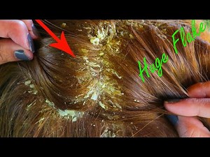 Dry Flaky Scalp Removal!! Dandruff Scratching Big Flakes With Black Comb Itchy Psoriasis