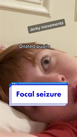 Understanding Focal Seizures: Symptoms, Awareness, and Risks